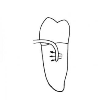 Кюрета пародонтологическая для квадрантов 2 и 4 Interproximal Curette SV 2-4 LM 252-254