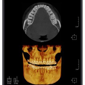 RAYSCAN Symphony a-OCL – ортопантомограф c цефалостатом (One Shot), 33х33 см